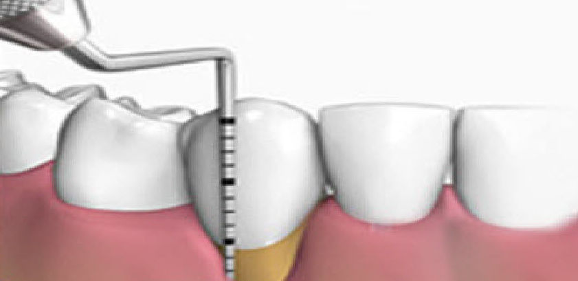 PERIODONCIA: Tratamientos de Clínica Dental Ángel Artiz PERIODONCIA: Tratamientos de Clínica Dental Ángel Artiz