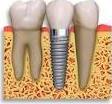 IMPLANTES CON CIRUGÍA: Tratamientos de Clínica Dental Ángel Artiz IMPLANTES CON CIRUGÍA: Tratamientos de Clínica Dental Ángel Artiz