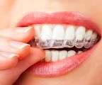 ORTODONCIA: Tratamientos de Clínica Dental Ángel Artiz ORTODONCIA: Tratamientos de Clínica Dental Ángel Artiz