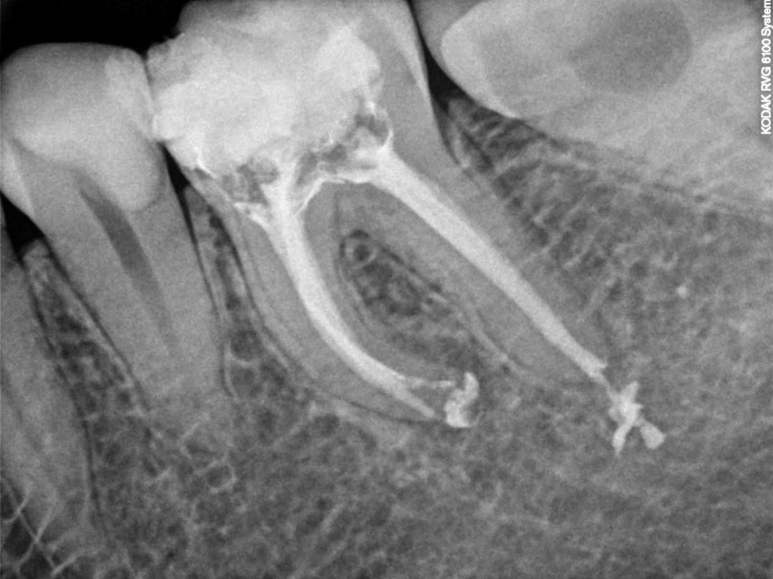ENDODONCIA: Tratamientos de Clínica Dental Ángel Artiz ENDODONCIA: Tratamientos de Clínica Dental Ángel Artiz