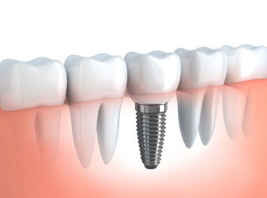IMPLANTES CON CIRUGÍA: Tratamientos de Clínica Dental Ángel Artiz IMPLANTES CON CIRUGÍA: Tratamientos de Clínica Dental Ángel Artiz