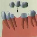 PRÓTESIS FIJA Y REMOVIBLE: Tratamientos de Clínica Dental Ángel Artiz PRÓTESIS FIJA Y REMOVIBLE: Tratamientos de Clínica Dental Ángel Artiz