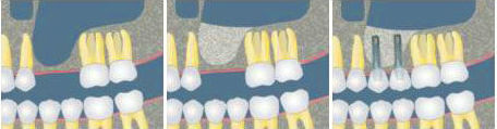ELEVACIÓN DE SENO MAXILAR: Tratamientos de Clínica Dental Ángel Artiz ELEVACIÓN DE SENO MAXILAR: Tratamientos de Clínica Dental Ángel Artiz