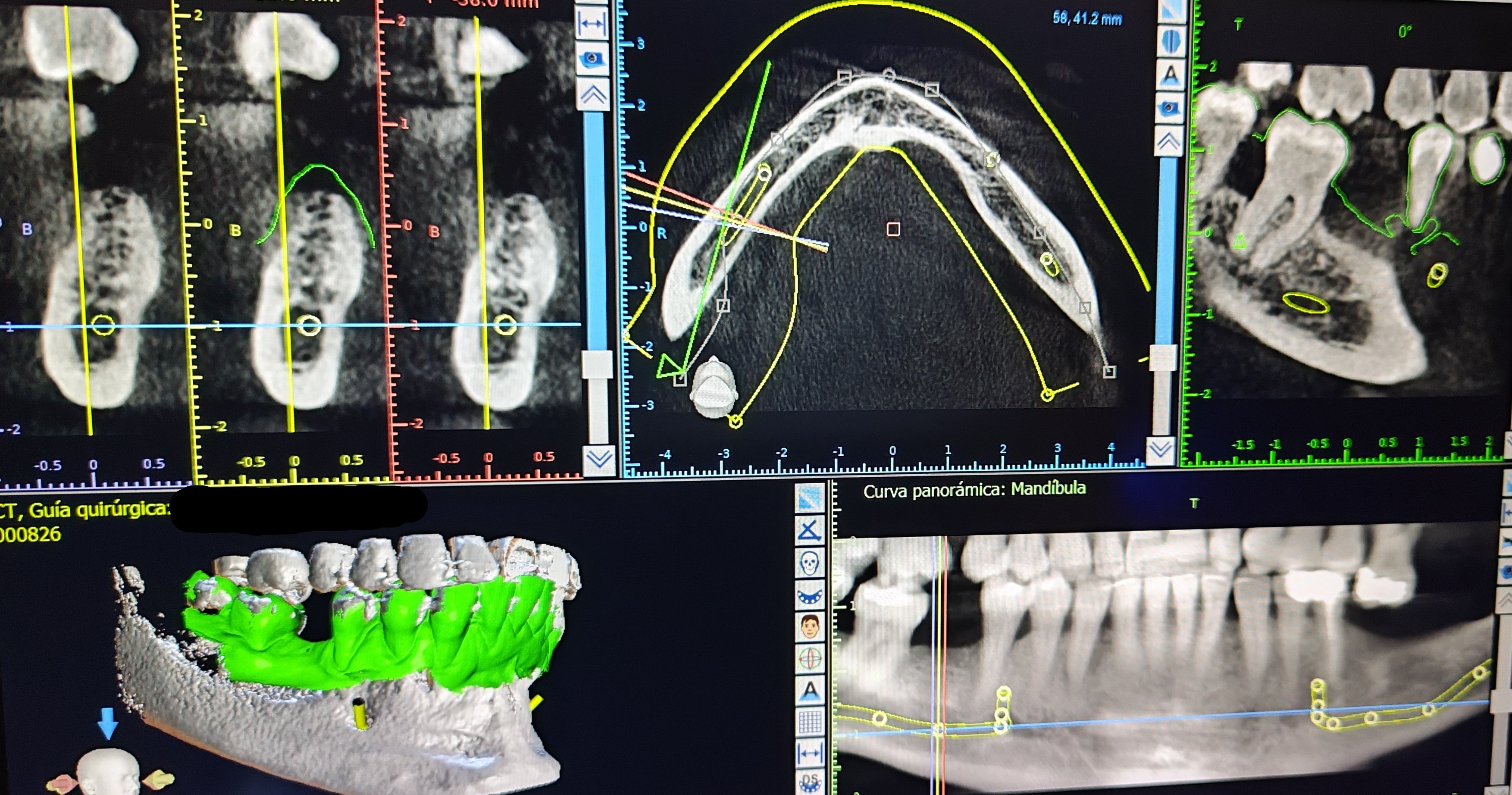 Esáner intraoral y radilogía tridimensional: Tratamientos y Productos de Odontología Integral Fernando Román