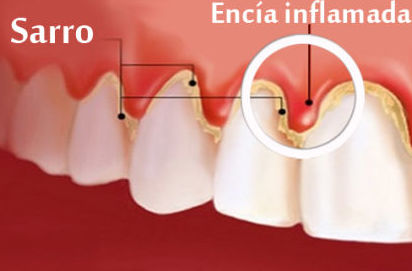 Raspados y Alisados Radiculares (curetaje): Tratamientos y Productos de Clinica Dental Fernando Román