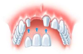 Prótesis dental fija en Santiago de compostela Prótesis dental fija en Santiago de compostela
