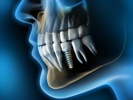 Especialista en implantes dentales en Hortaleza, Madrid