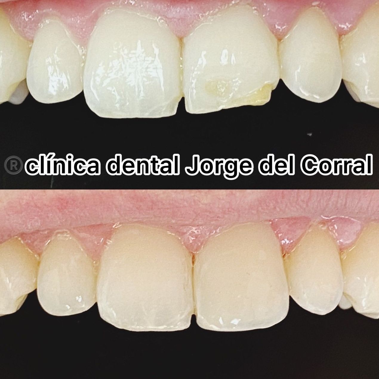 Especialistas en carillas dentales en Madrid, dentista en Madrid, implantes dentales en Madrid, ortodoncia dental en Madrid, urgencias dentales en Madrid