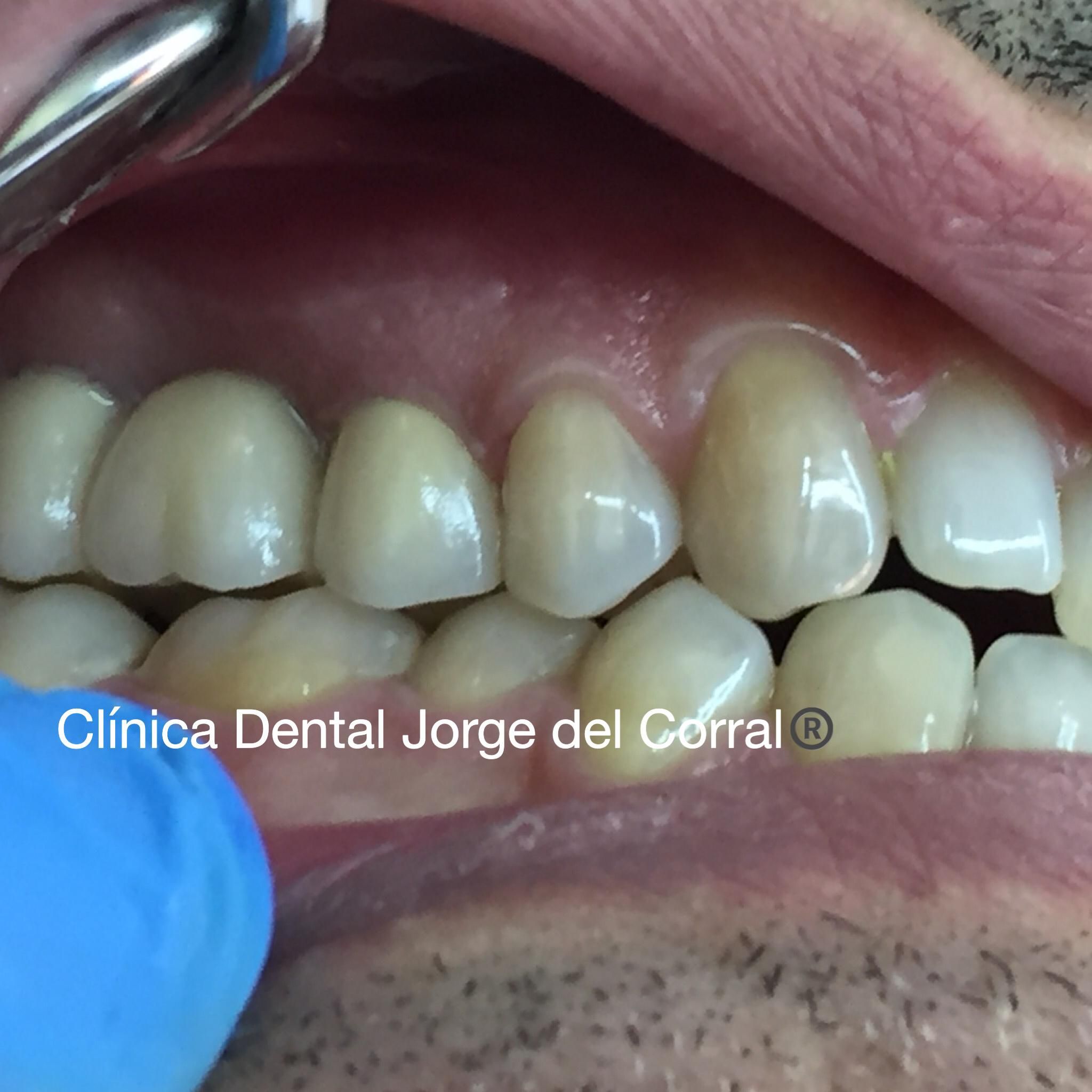 Estética Dental Hortaleza - Zirconio - Disilicato de Litio - Cerámica sin metal - Hortaleza
