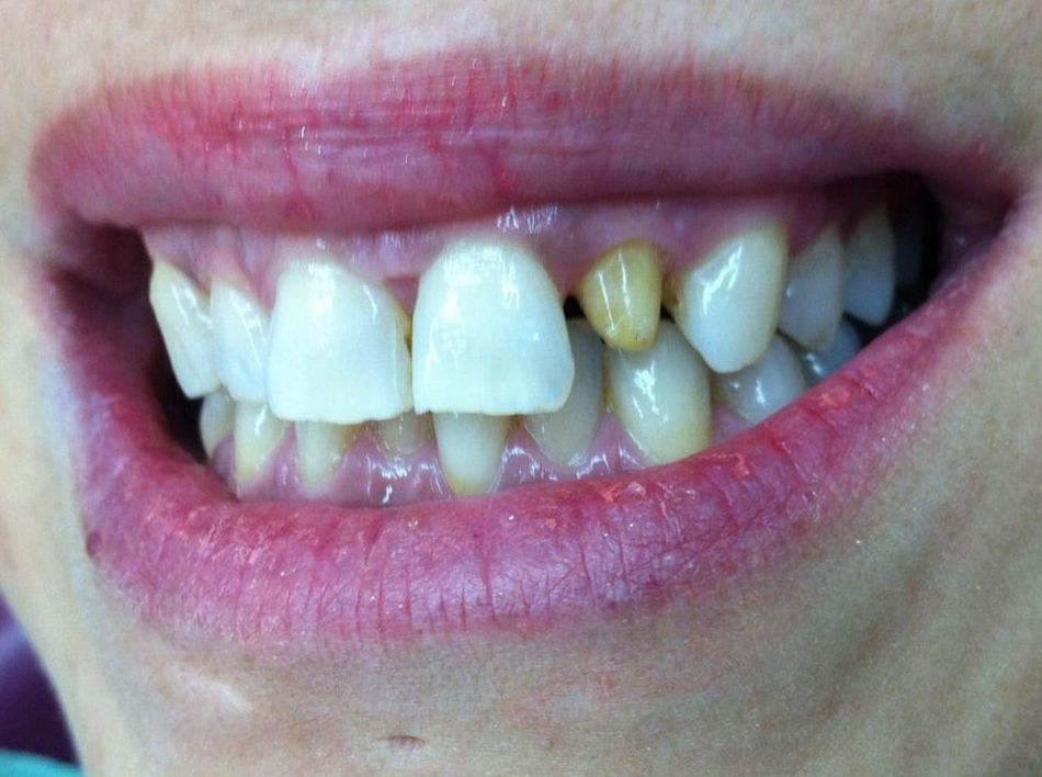 Protesis Fijas en hortaleza Disilicato de Litio - Ceramica sin metal ( antes ) Protesis Fijas en hortaleza Disilicato de Litio - Ceramica sin metal ( antes )