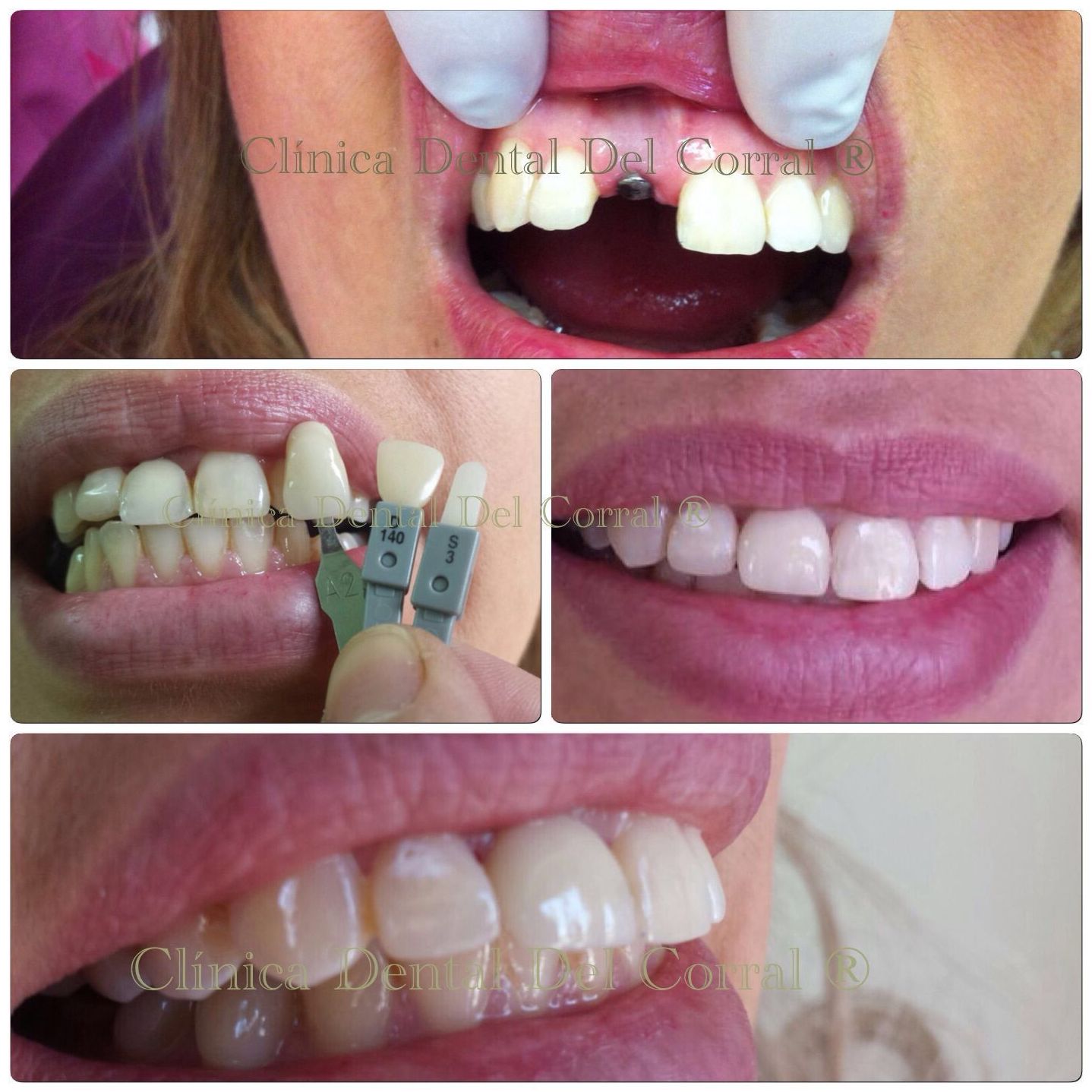Implantes dentales en Hortaleza