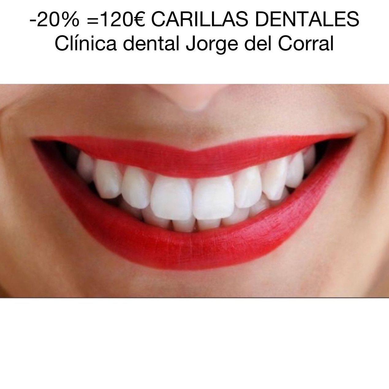 Oferta -20%=120€ de carillas dentales de composite en Madrid-Hortaleza-Canillas