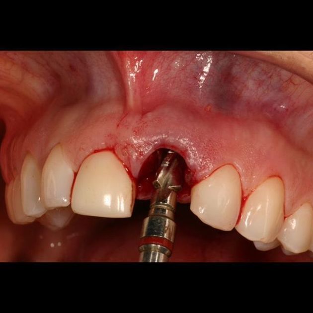 Implantología: Servicios de Clínica dental ulident Implantología: Servicios de Clínica dental ulident