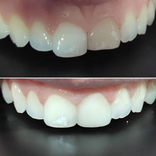 Carillas de composite: Servicios de Clínica dental ulident Carillas de composite: Servicios de Clínica dental ulident