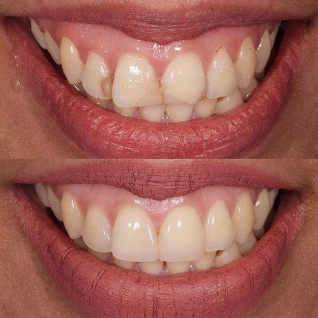 Carillas de composite: Servicios de Clínica dental ulident Carillas de composite: Servicios de Clínica dental ulident
