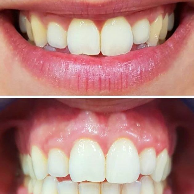 Blanqueamiento dental domiciliario: Servicios de Clínica dental ulident Blanqueamiento dental domiciliario: Servicios de Clínica dental ulident