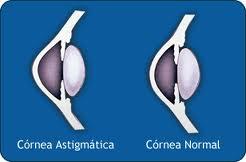 Astigmatismo: Tratamientos de Consulta Roberto Conde Seoane Astigmatismo: Tratamientos de Consulta Roberto Conde Seoane