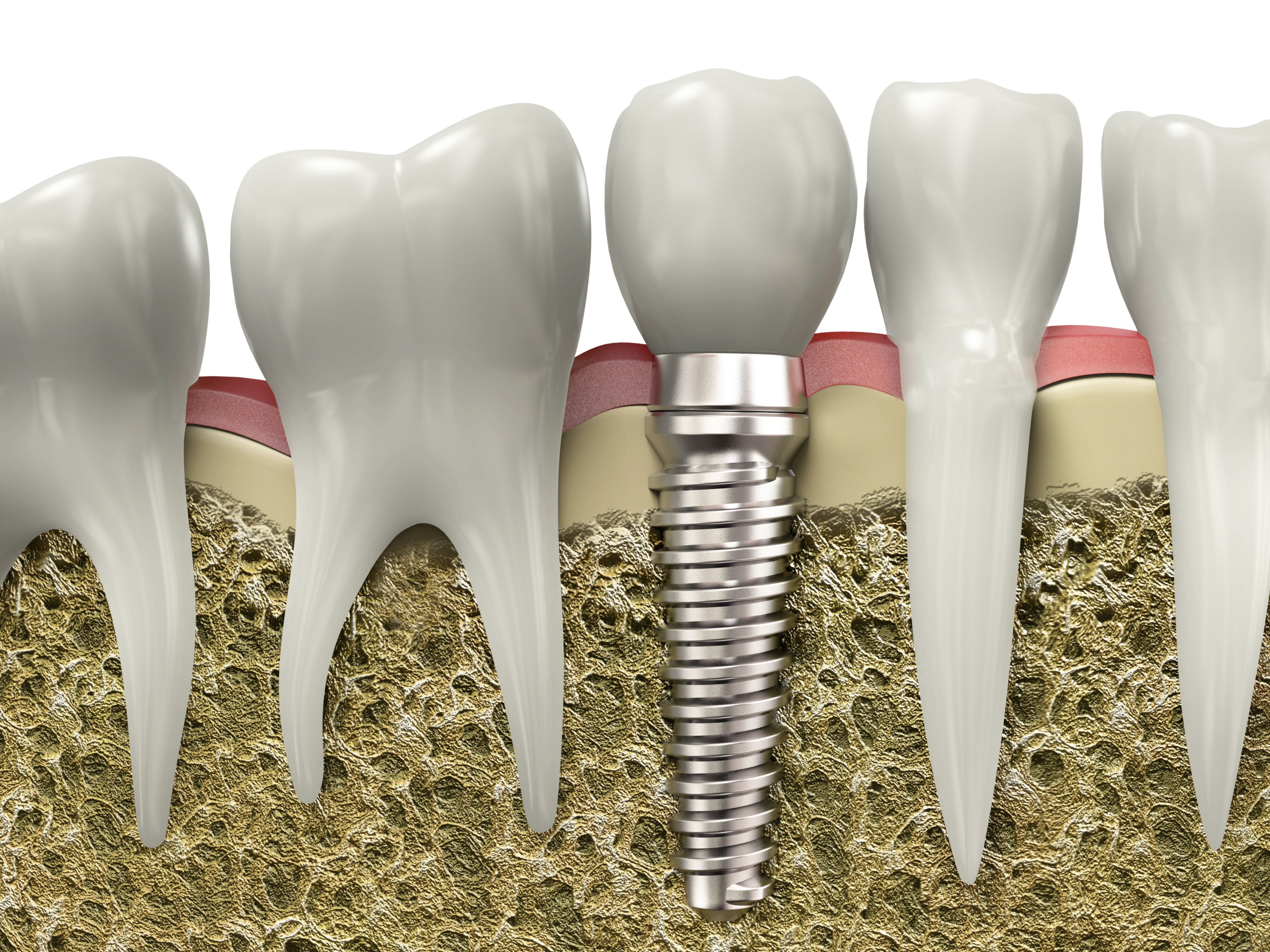 Implantes dentales en Trujillo