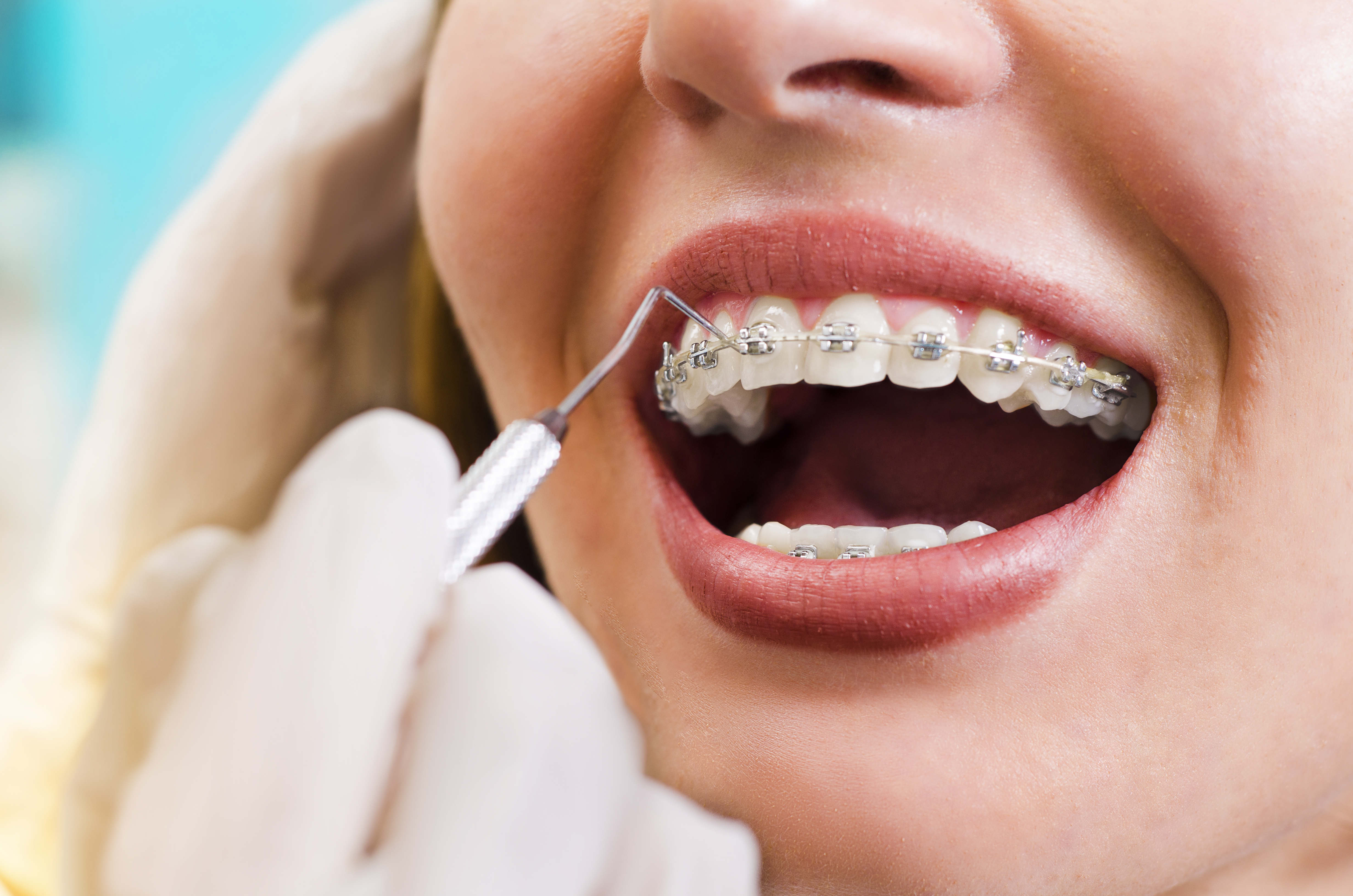 Ortodoncia rápida: Especialidades de Clínica Dental Dr. Bassanini Ortodoncia rápida: Especialidades de Clínica Dental Dr. Bassanini