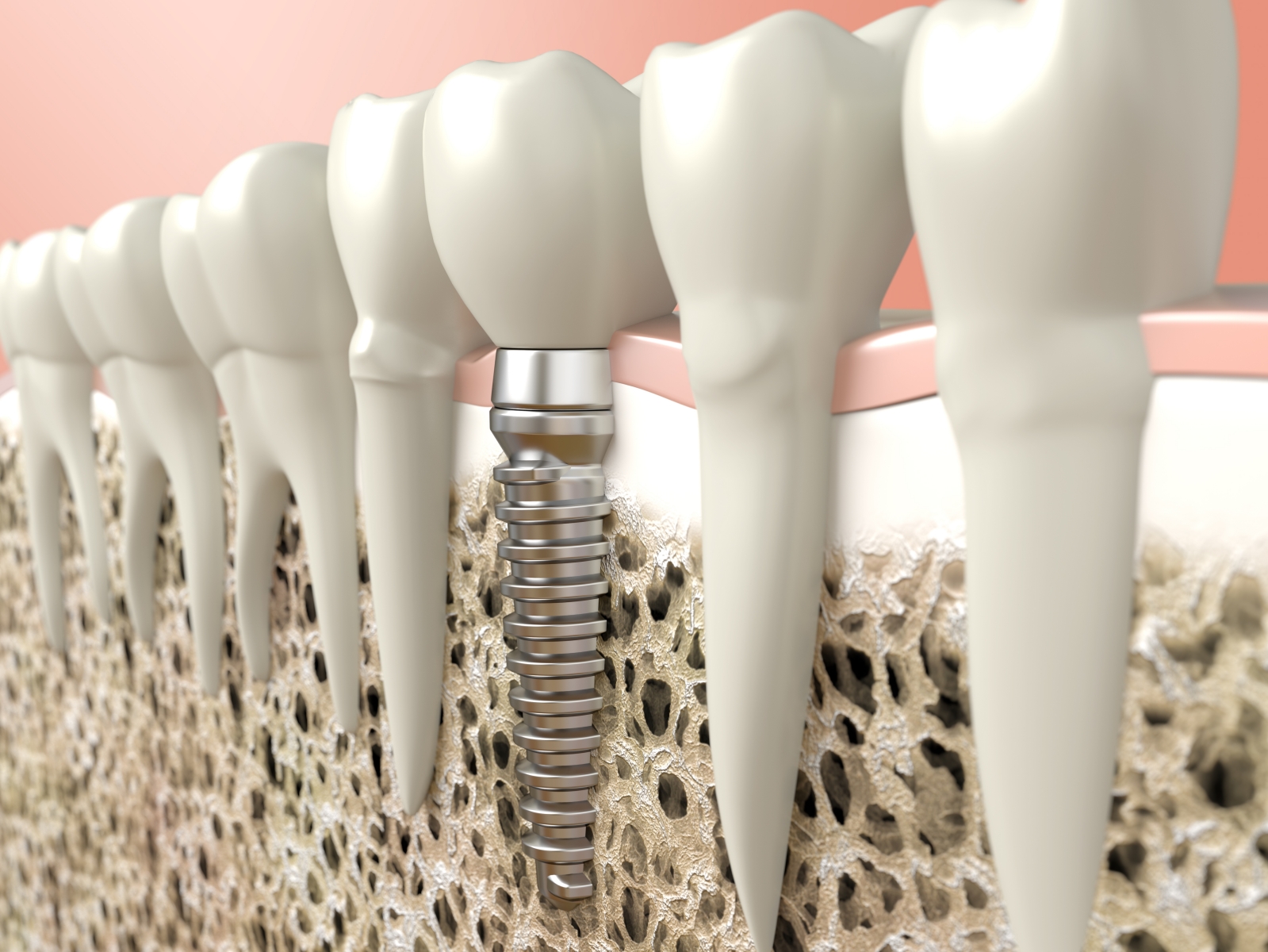 Implantes dentales: Especialidades de Clínica Dental Dr. Bassanini Implantes dentales: Especialidades de Clínica Dental Dr. Bassanini