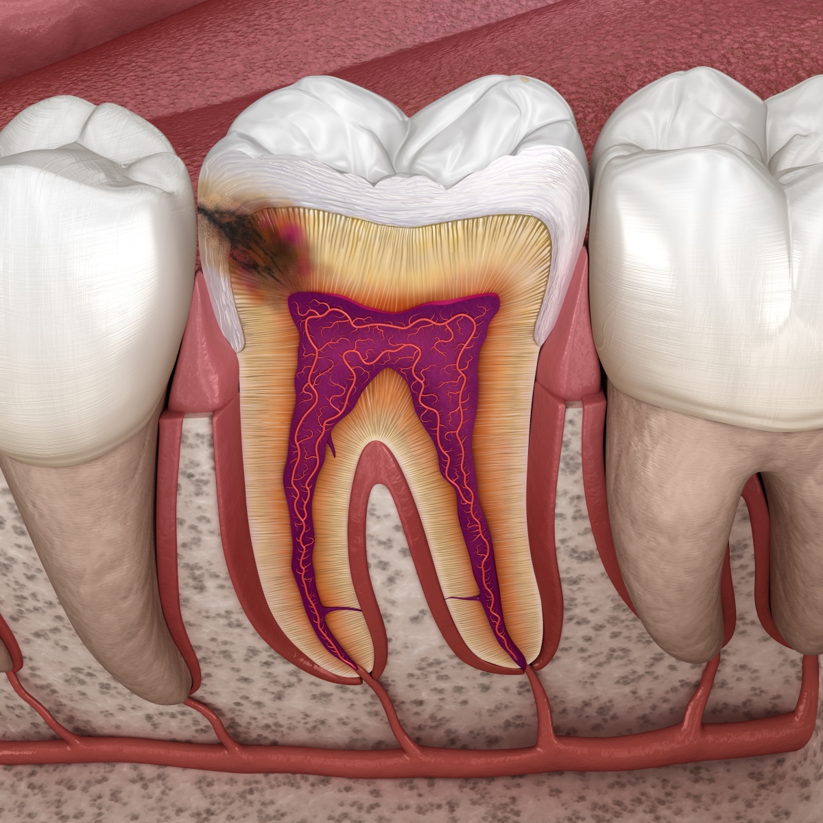 Endodoncia: Especialidades de Clínica Dental Dr. Bassanini Endodoncia: Especialidades de Clínica Dental Dr. Bassanini
