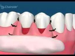 Cirugía periodontal a colgajo: Tratamientos de Clínica dental Neardental }}