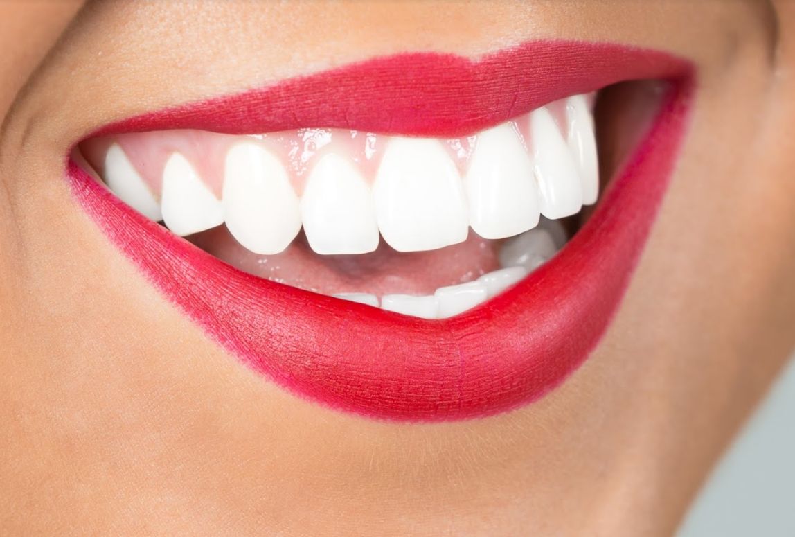 Carillas dentales: Catálogo de Clínica Dental Mª Teresa Garrido Carillas dentales: Catálogo de Clínica Dental Mª Teresa Garrido