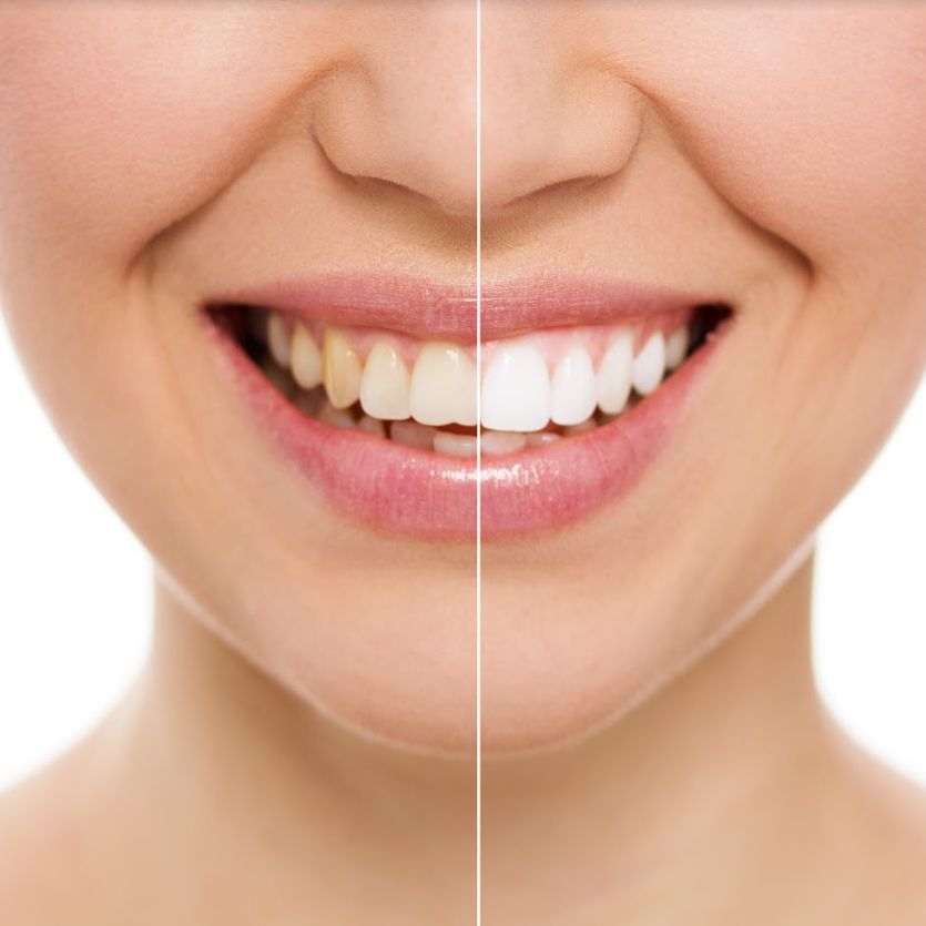 Blanqueamiento dental: Catálogo de Clínica Dental Mª Teresa Garrido Blanqueamiento dental: Catálogo de Clínica Dental Mª Teresa Garrido