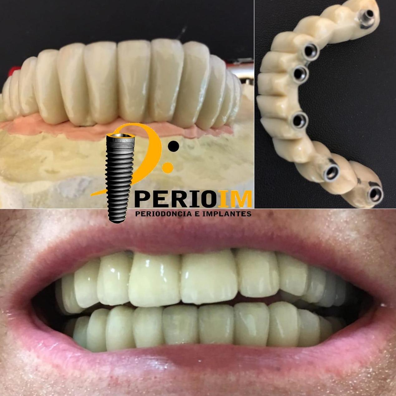 Puente metal cerámico sobre 6 implantes Puente metal cerámico sobre 6 implantes
