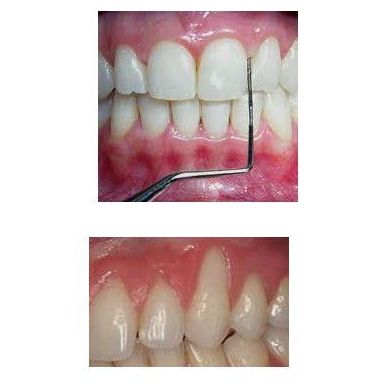 Periodoncia: Tratamientos of Perioim Periodoncia: Tratamientos of Perioim