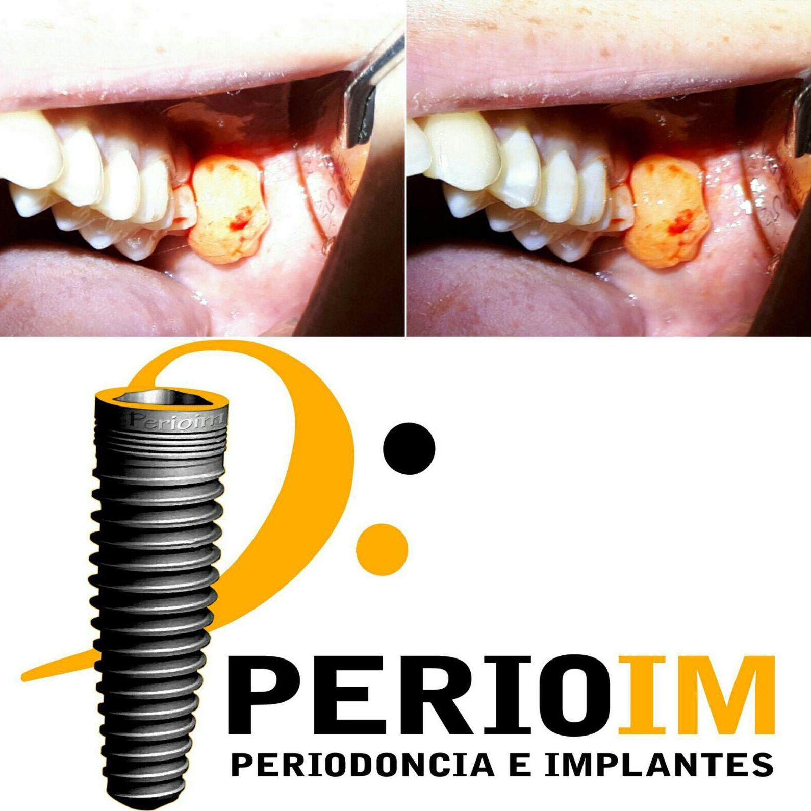 Implantes dentales Torrejón de la Calzada Implantes dentales Torrejón de la Calzada