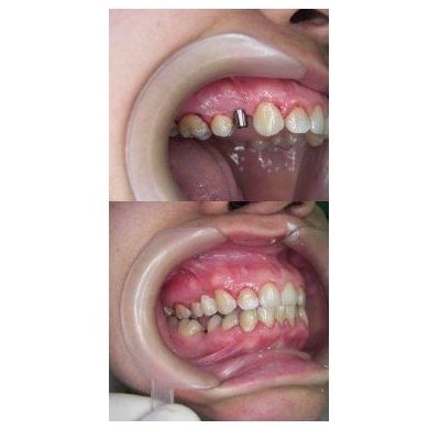Dientes en un día: Tratamientos de Perioim Dientes en un día: Tratamientos de Perioim