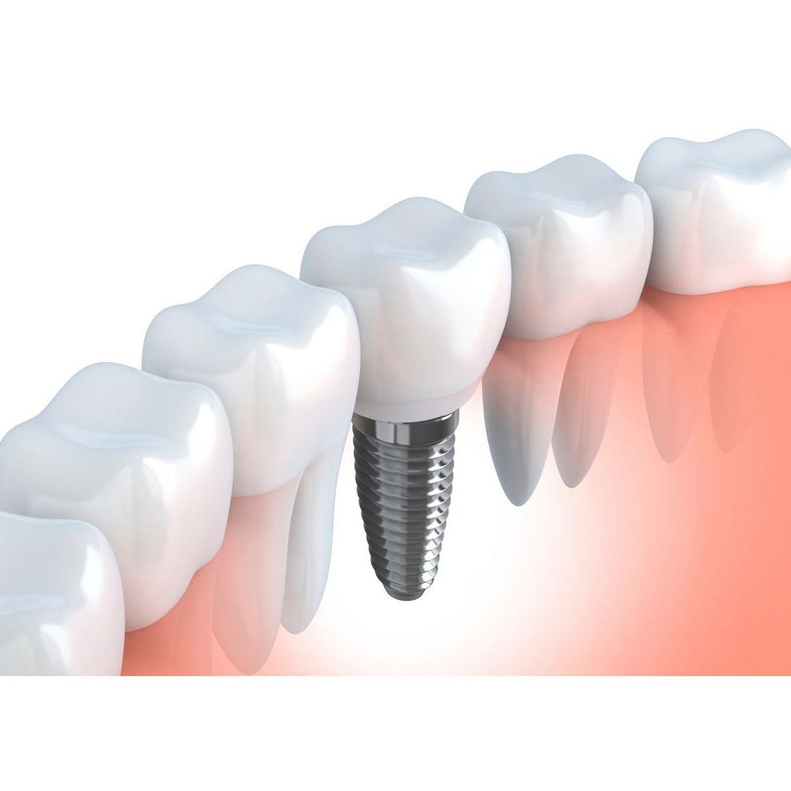 Implantología: Tratamientos de Perioim Implantología: Tratamientos de Perioim