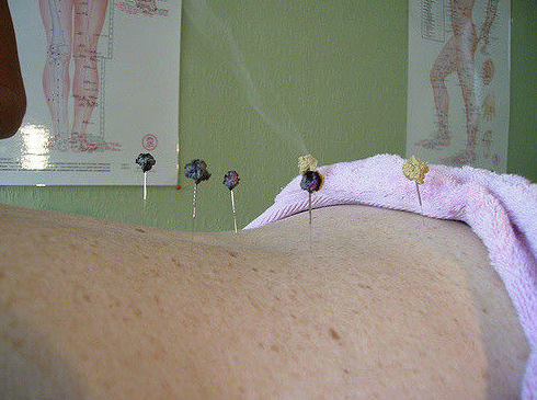 Moxibustión: Servicios de Acupuntura Médica Dr. Espinosa de los Monteros Moxibustión: Servicios de Acupuntura Médica Dr. Espinosa de los Monteros