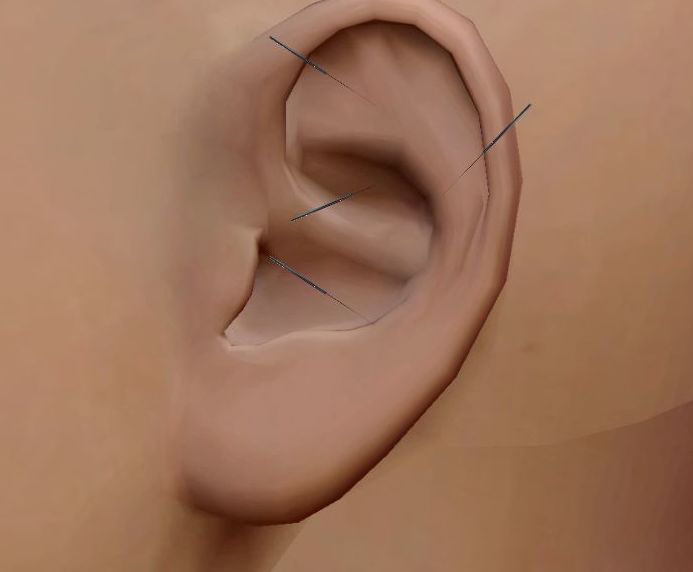Auriculoterapia: Servicios de Acupuntura Médica Dr. Espinosa de los Monteros Auriculoterapia: Servicios de Acupuntura Médica Dr. Espinosa de los Monteros