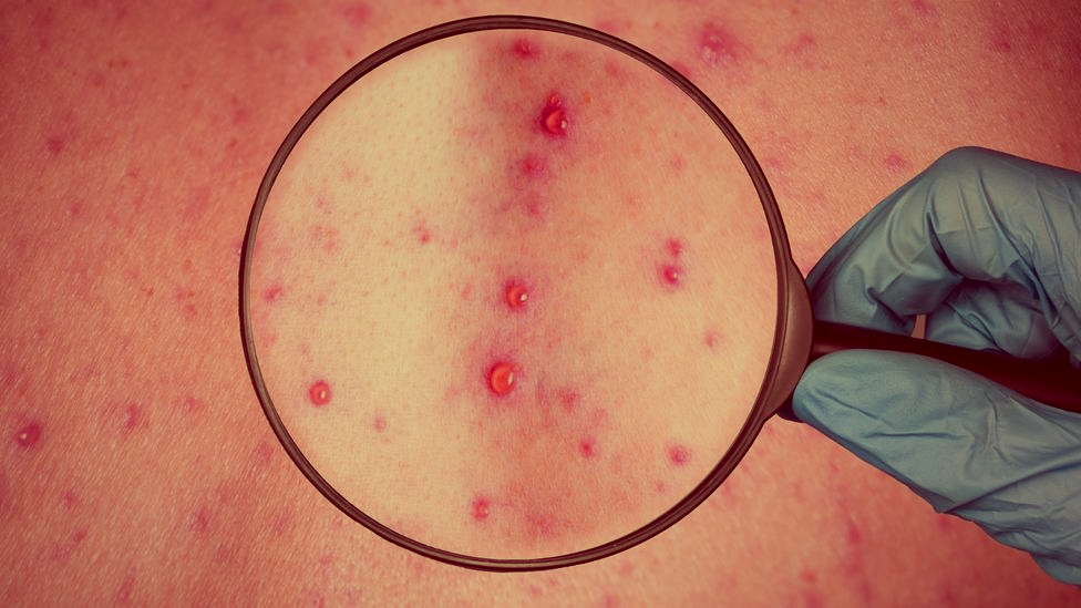 Síntomas para diferenciar la viruela del mono de otras lesiones en la piel