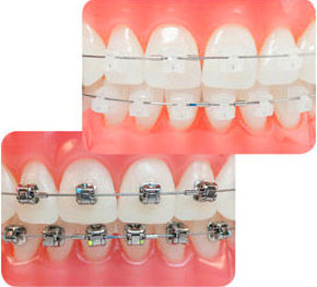 Ortodoncia dental fija (brackets): Tratamientos de Clínica Dental Dra. Carretero Ortodoncia dental fija (brackets): Tratamientos de Clínica Dental Dra. Carretero