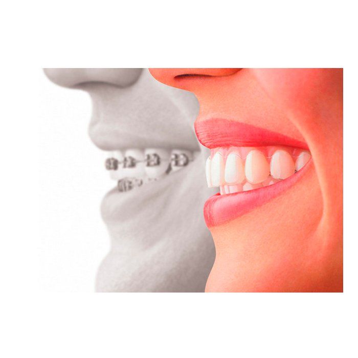 Ortodoncia invisible Invisalign Ortodoncia invisible Invisalign