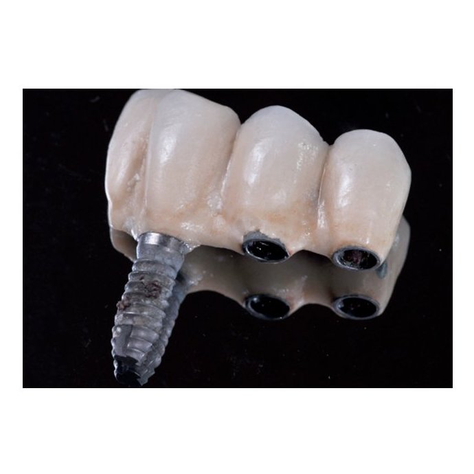 Implantes dentales Implantes dentales