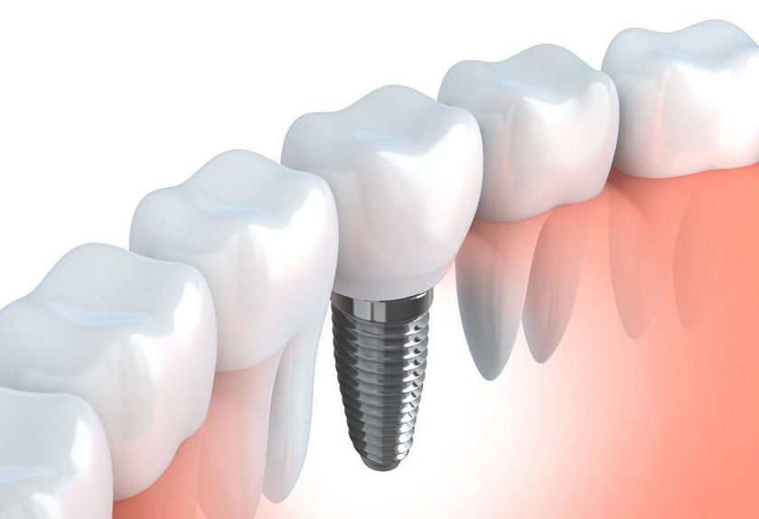 Implantes dentales: Tratamientos de Clínica Dental Dra. Carretero Implantes dentales: Tratamientos de Clínica Dental Dra. Carretero