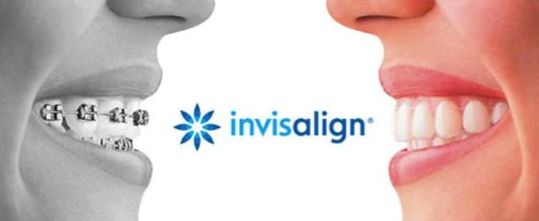 Ortodoncia invisible Invisaling Ortodoncia invisible Invisaling