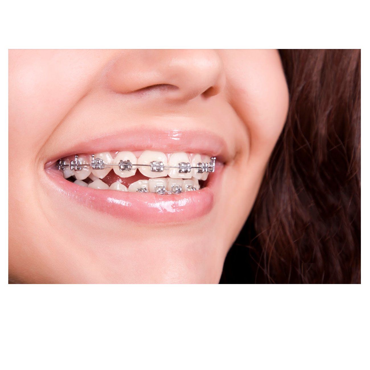 Ortodoncia dental Ortodoncia dental