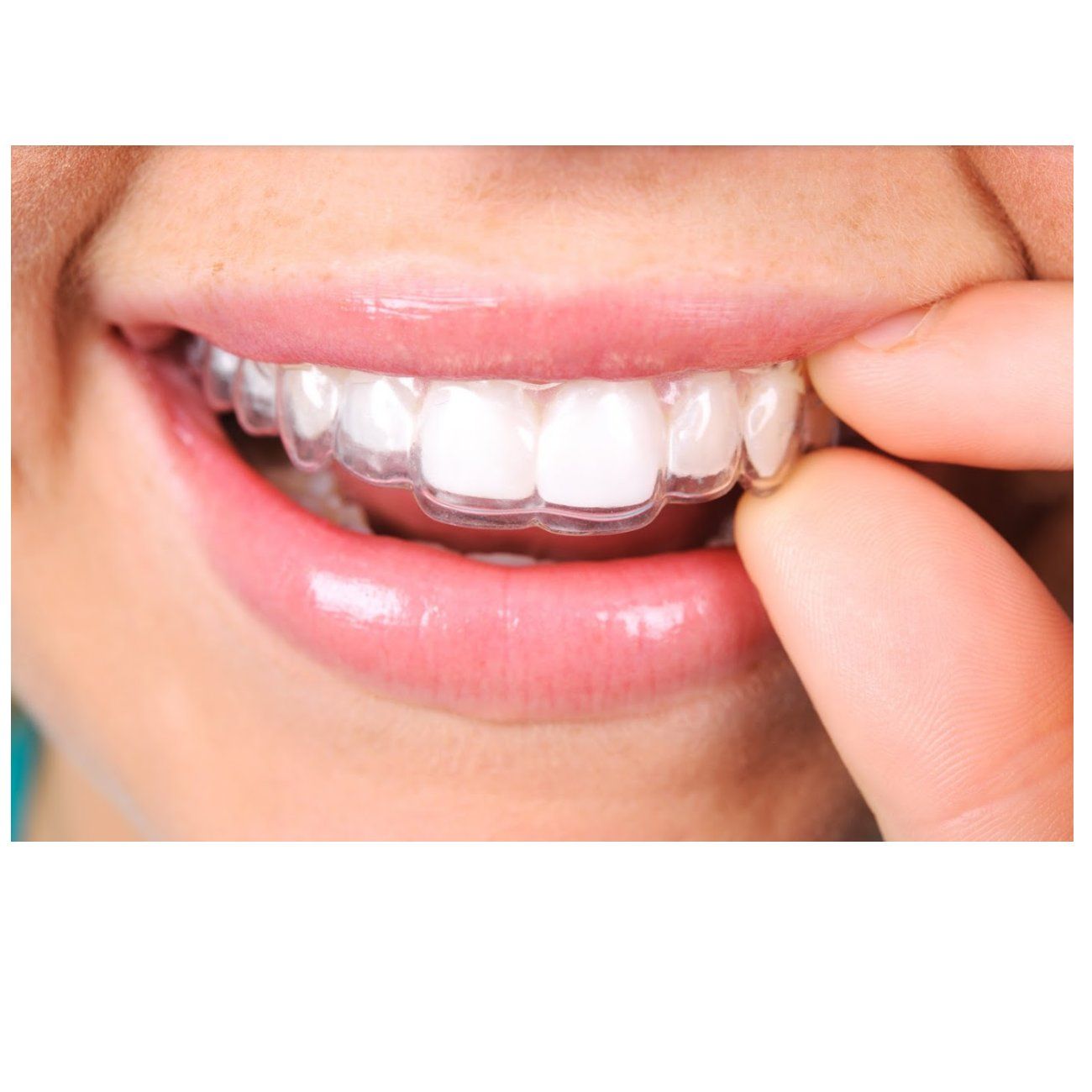 Férula dental Férula dental
