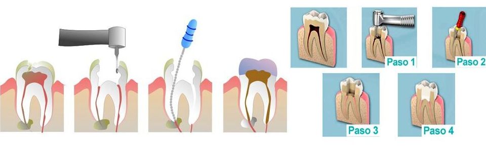 Endodoncia : Servicios de Clínica Dental Dr. Javier Pérez Martínez N.I.C.A. 27795 Endodoncia : Servicios de Clínica Dental Dr. Javier Pérez Martínez N.I.C.A. 27795