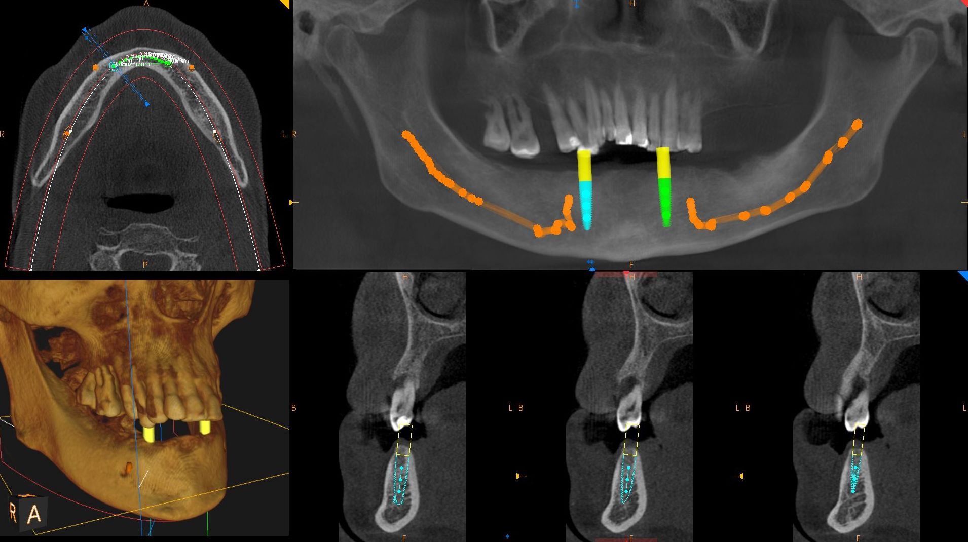 implantes protesis javier perez dentista