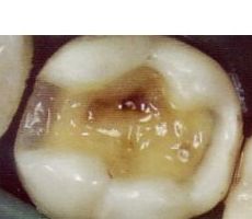 Empastes : Servicios de Clínica Dental Dr. Javier Pérez Martínez N.I.C.A. 27795 Empastes : Servicios de Clínica Dental Dr. Javier Pérez Martínez N.I.C.A. 27795