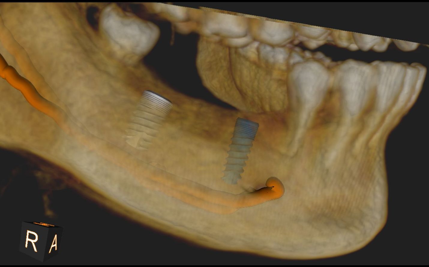 Dentista Javier Perez implantes