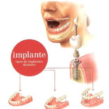 Implantes : Servicios de Clínica Dental Dr. Javier Pérez Martínez N.I.C.A. 27795 Implantes : Servicios de Clínica Dental Dr. Javier Pérez Martínez N.I.C.A. 27795