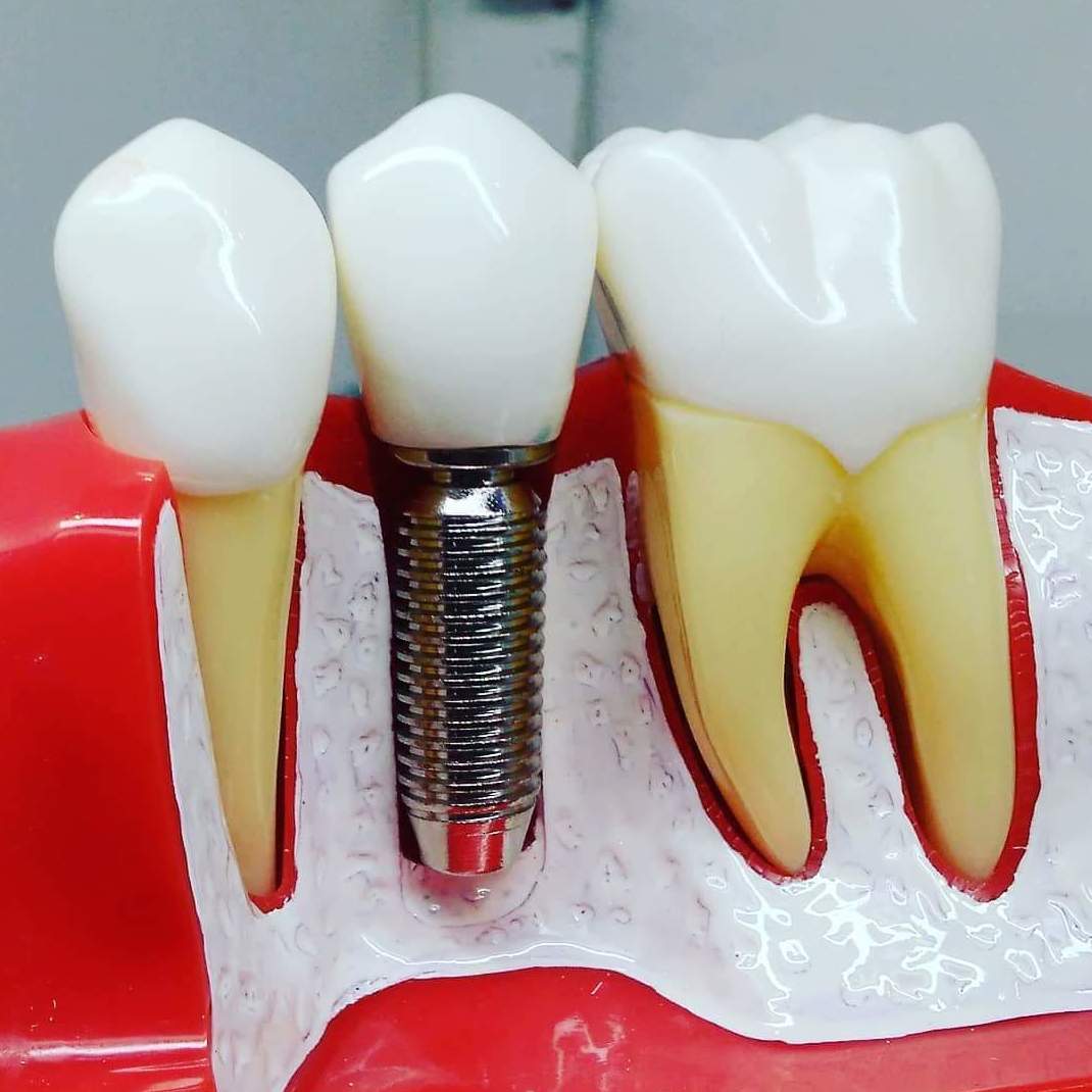 dentista en cadiz implantes arte dental