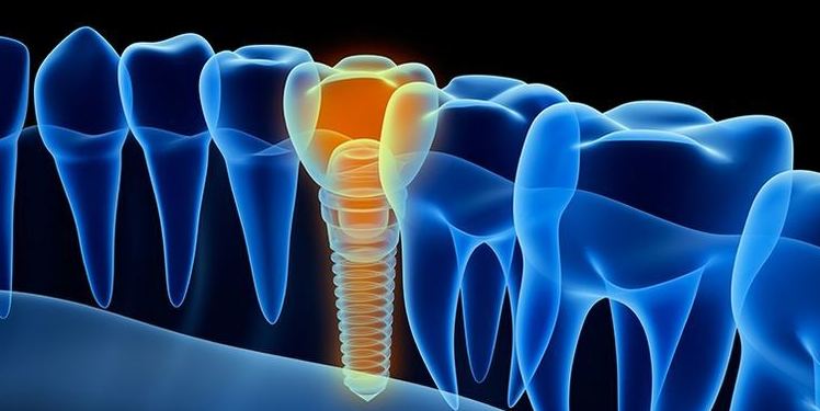 dentista en cadiz implantes 